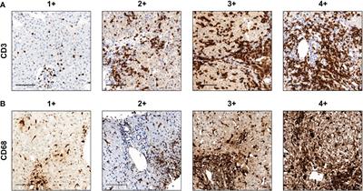 Intrahepatic infiltration of activated CD8+ T cells and mononuclear phagocyte is associated with idiosyncratic drug-induced liver injury